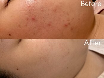 カレンジェビューティー(CarengeBeauty)/プラズマピュア