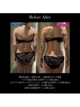 フェレザ 新潟(Felleza)/キャビテーションで脂肪撃退