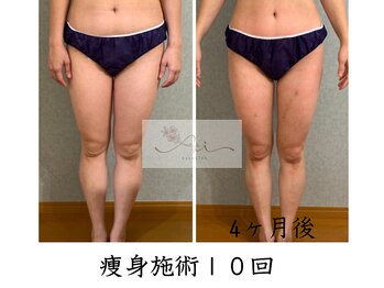 アイ エステサロン(Ai)/【30代】美脚へ♪太もも・お尻も