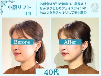 フローフシ∞/【小顔】切らない小顔リフト
