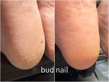 バドゥネイル(bud nail)/足裏角質除去/フットケア
