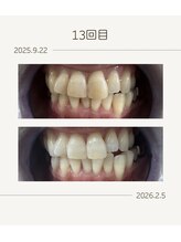 ホワイトニングショップ 福岡姪浜店/お客様before after