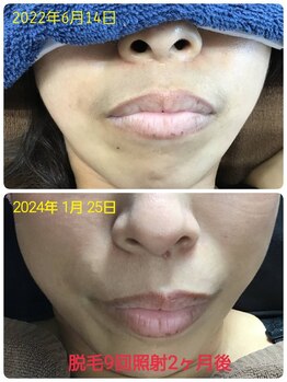 ソレイユ/レディース脱毛