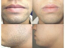 ブブオム 恵比寿本店(BUB OMME)/スピード美肌ヒゲ脱毛3ヶ所