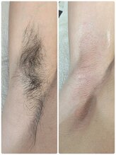 ハグ(Hug)/ワキダブル脱毛