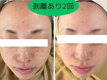 フローラエイトビューティー(FLORA∞ BEAUTY)の雰囲気（剥離ありのハーブピーリングでツルツル美肌に♪）