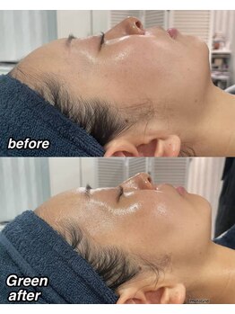 ニゲラ(Nigella)/エルモサハーブピーリング