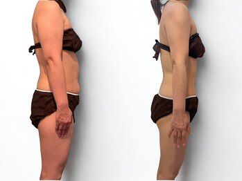 サルサナ(Salu Sana)/痩身！40代更年期太りでお悩み