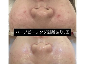 ソアン(Soin)/ハーブピーリング