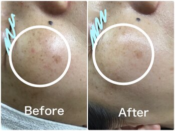 ラウレア(LAULEA)/シミ改善Before/After（2ヶ月）