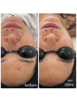 リアム(LiAm)/ツヤ肌 第4世代ララピール