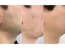 クリアランス(CLEARANCE)/青ヒゲ卒業！ゴリラ脱毛！