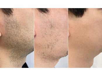 クリアランス(CLEARANCE)/青ヒゲ卒業！ゴリラ脱毛！