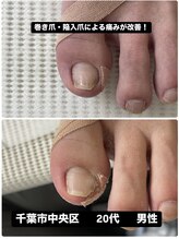 巻き爪じゅん 千葉駅前店/巻き爪・陥入爪による痛みが改善