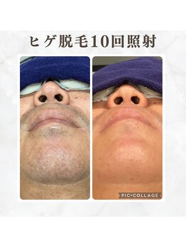 ボゴス(BOGOSS)/ヒゲ脱毛10回照射