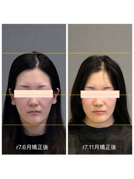 プライミー(PRIMY)/面長改善