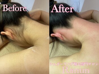 ラナン(Ranun)/VIOと同じくらい人気の背面全部