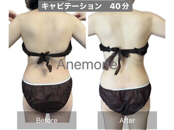 アネモネ/ダイエット/痩身/耳つぼ/腸活