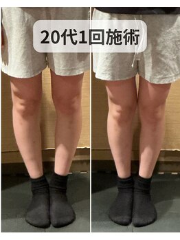 ミーツ(MEETS)/O脚