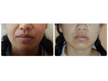 小顔矯正アンドフェイシャルサロン アンベリール(embellir)/小顔矯正ビフォーアフター３