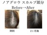 圧倒的効果【頭皮ケア】ノアグロウ導入！部分的な頭皮悩みの方