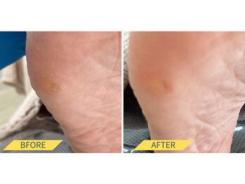 ふっとけ庵/魚の目ケア