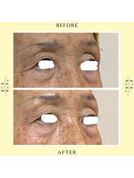 シスタス(Cistus)/ExoLiftビフォーアフター