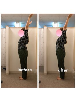 みらい整骨院/肩甲骨の可動範囲UPで肩こり改善