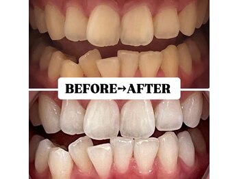 ホワイトニングサロン 豊中/Before&After美白ホワイトニング