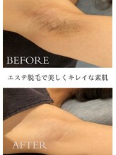 シャーロック(4869Sherlock)&nbsp;毛穴ケア 脱毛