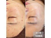 アイビーケア 三田(ivy care)の雰囲気（エクソソームハーブピーリングで大人にきび、毛穴改善。シミ予防）