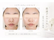 ユアーズ ビューティー(YOURS beauty)の雰囲気（施術直後から実感。うるおい満ちる水光肌へ）