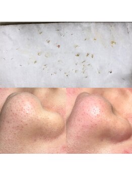 ビューティーネイル(Beauty Nail)/毛穴エクストラクション