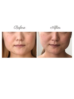 ウルエッテ(UluEtte)/エラ張り/エラの悩み/福岡小顔