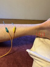 ライズ/下腿の施術