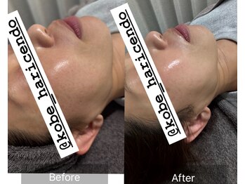 ハリシェンド/WiQOピール