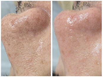 アン(anne)/☆毛穴洗浄ハイドロスキン×5回