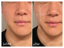 ミースプラス(me,as+)/高周波サーマ 全顔1回 (術直後)