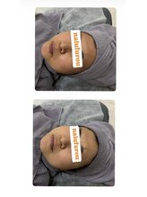 ナルフロウ(nalufurou)/剥離なし国産ハーブピーリング☆