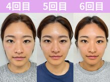 ナチュラルビューティーフェイス 横浜(NBF)/小顔矯正/ビフォーアフター