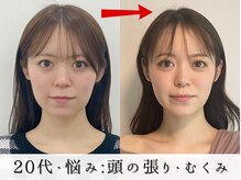 ジョンミー(JONMEE)/小顔矯正で左右差改善！