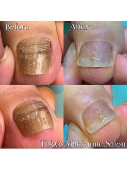 巻き爪補正店 越谷店/変形爪補正