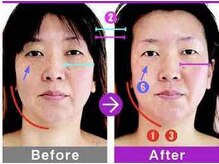 ラヴィアンローズ(LavieenRose)/πセラピー小顔矯正術の効果