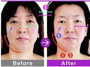 ラヴィアンローズ(LavieenRose)/πセラピー小顔矯正術の効果