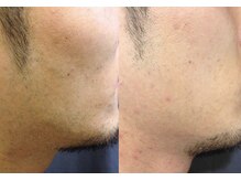 ブブオム 恵比寿本店(BUB OMME)/スピード美肌ヒゲ脱毛3ヶ所