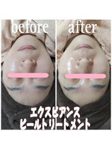 ピュルテ/水光ピールでツヤ復活！