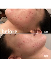 リモアボーテ(RIMOA beaute)/【ニキビ】before