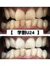 【学割U24】白い歯に！セルフホワイトニング8分×3照射★¥5100→￥3000