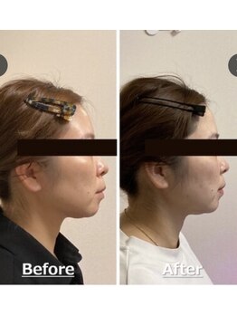 小顔22 ボルティ 本店(Bolty)/小顔シンメトリー矯正&全身矯正