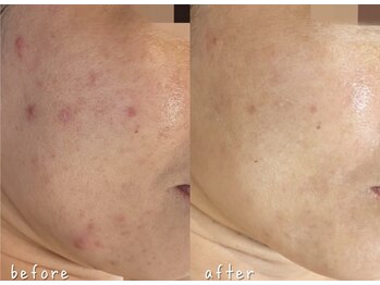 エヌエースキン たまプラーザ店(NAskin)/ハーブピーリング|ニキビケア